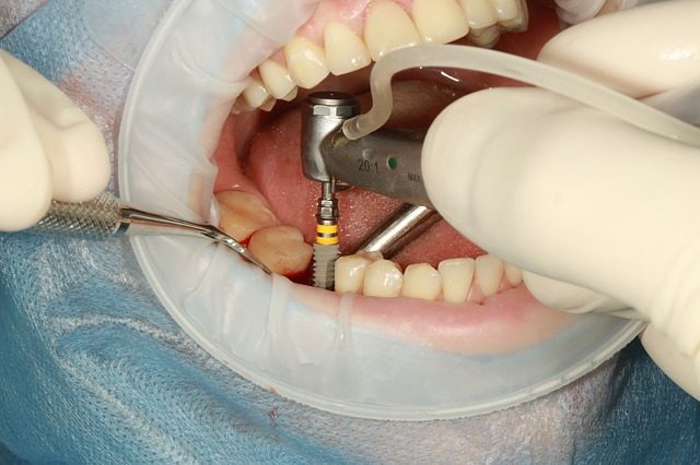 extractii dentare in sector 4